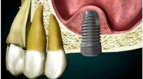 همه چیز در مورد سینوس لیفت در ایمپلنت دندان ؛هزینه، مراحل و مراقبت ها