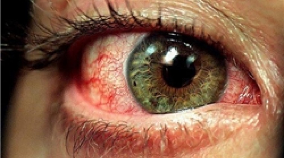 آنچه در مورد آلرژی‌های چشمی باید بدانید