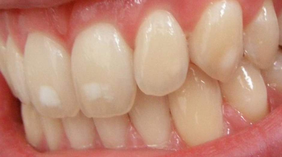 رهایی از لکه‌های سفید دندان‌