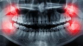 دندان عقل همیشه کشیدنی نیست