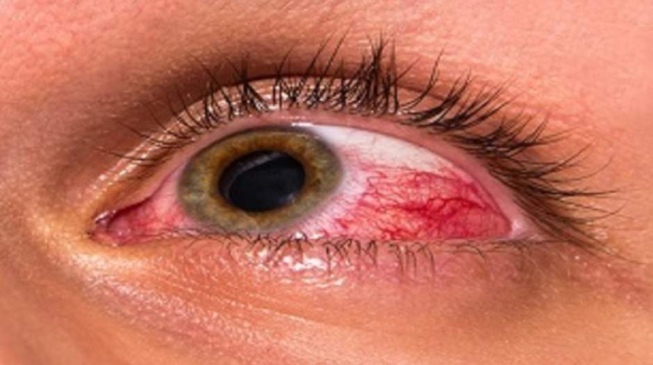 قرمزی چشم چه زمانی خطرناک است؟