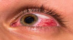 قرمزی چشم چه زمانی خطرناک است؟