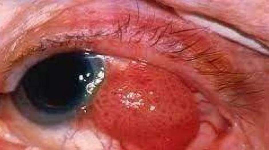 علائم نشان دهنده ابتلا به سرطان چشم