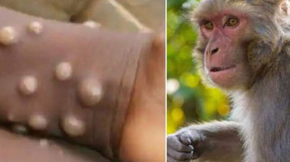 کدام سویه آبله میمون خطرناک‌تر است؟