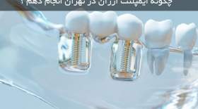 چگونه ایمپلنت ارزان در تهران انجام دهم ؟
