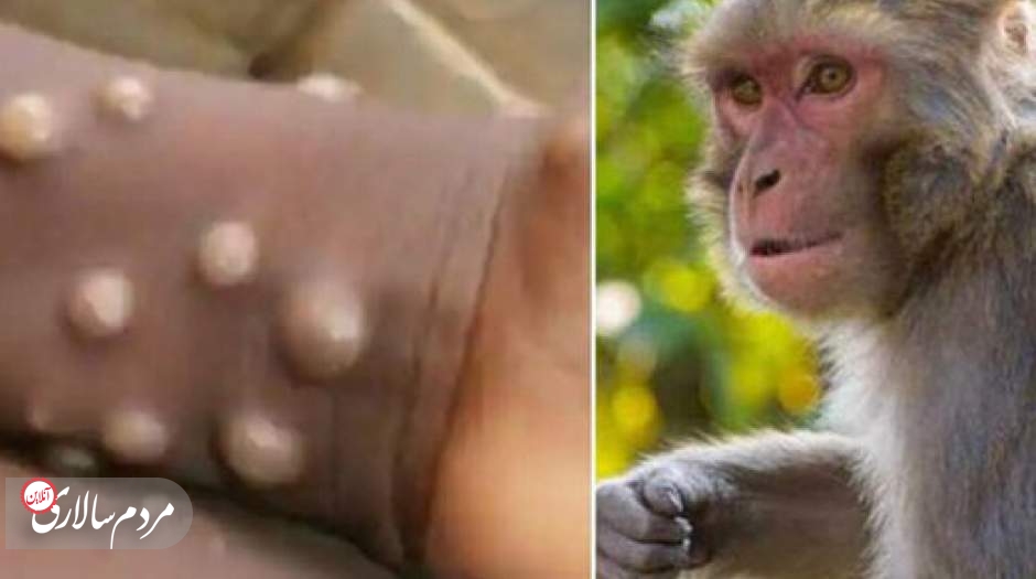 اولین بیمار مبتلا به آبله میمونی در ایران اهل کجاست؟