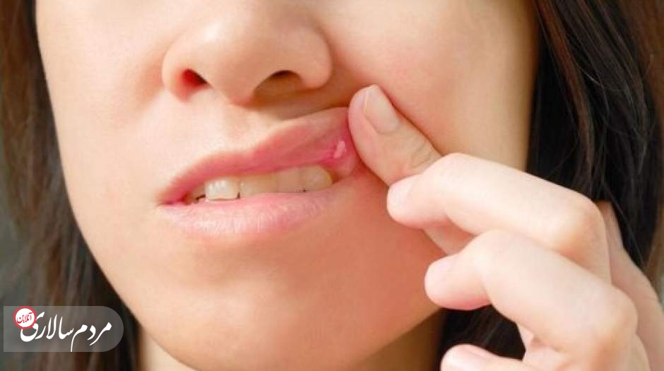علت اصلی آفت‌های دهان چیست؟