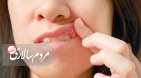 علت اصلی آفت‌های دهان چیست؟