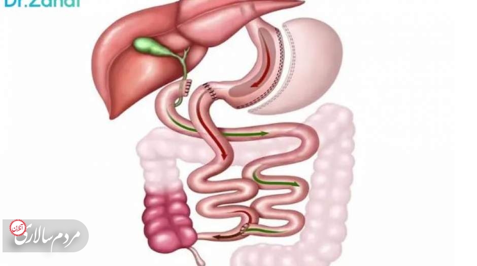 جراحی اسلیو معده و درمان چاقی مفرط