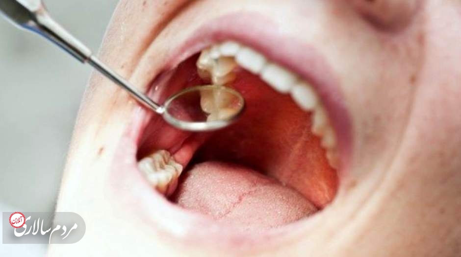 پوسیدگی دندان این بلا را سر بقیه اعضای بدن می‌آورد