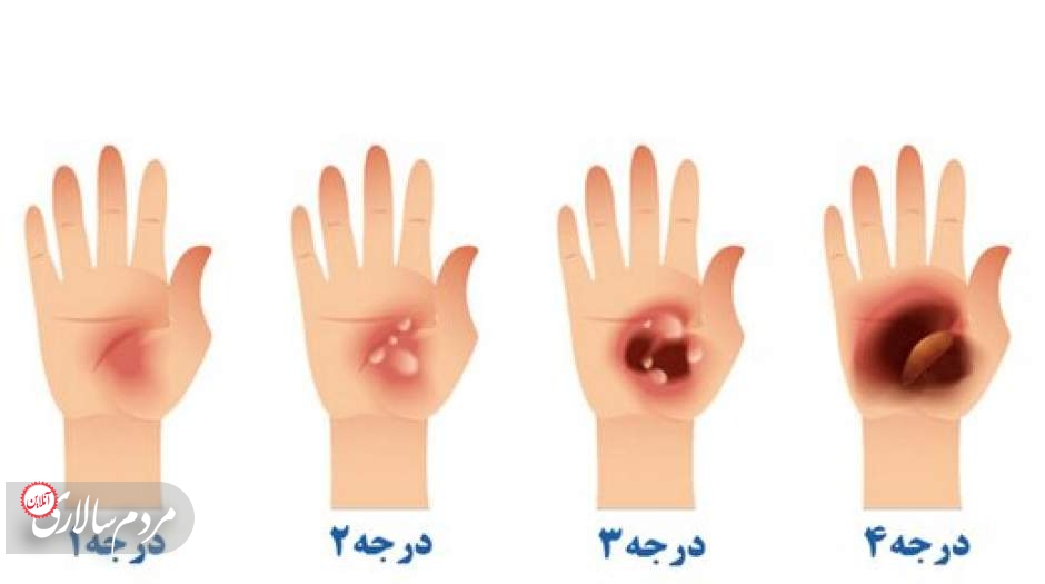 اولین اقدام بعد از سوختگی